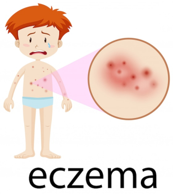 A Boy Having Eczema on Body Skin A Boy Having Eczema on Body Skin