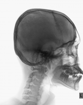 A Schedel AP radiograph of the skull on white background A Schedel AP radiograph of the skull on white background