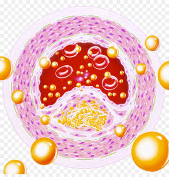 Arteriosclerosis Blood vessel Artery Cardiovascular disease Health - Blood lipids 