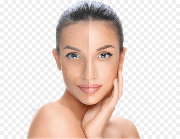 Chemical peel Facial Skin Exfoliation Surgery - mulberry Chemical peel Facial Skin Exfoliation Surgery - mulberry