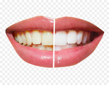 Cosmetic dentistry Tooth whitening - Teeth Whitening Cosmetic dentistry Tooth whitening - Teeth Whitening