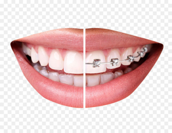 Dental braces Clear aligners Orthodontics Tooth Dentistry - Teeth With Braces 