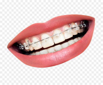Dental braces Dentistry Orthodontics Tooth Clear aligners - Teeth With Braces 