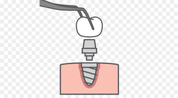 Dental implant Clothing Accessories Illustration Joke - atrophy illustration 
