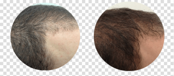 Hair Growth Transparent Image Hair Growth Transparent Image