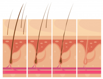Hair loss storyboard conceptual compositions set Free Vector Hair loss storyboard conceptual compositions set Free Vector