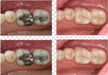 Hillcrest Dentist - Cerec in San Diego | Family Dental | Padre ...