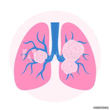 Lung cancer signs Lung cancer signs