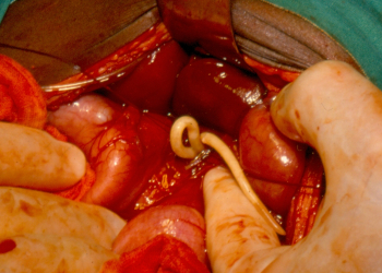 Soil-transmitted helminthiasis - Wikipedia Soil-transmitted helminthiasis - Wikipedia