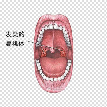 Tonsillitis Inflammation Symptom Disease, Cancer lesions transparent background PNG clipart