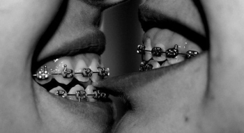 Two people touch their mouths with their tongues, they have braces Two people touch their mouths with their tongues, they have braces