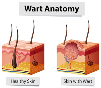 Wart Human Skin Anatomy Illustration Wart Human Skin Anatomy Illustration